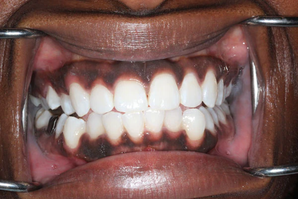After image