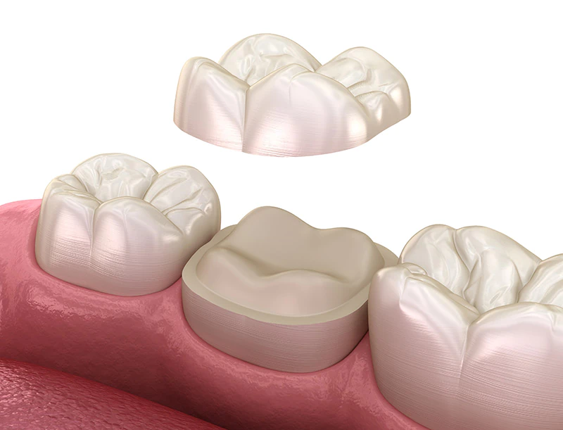 dental crowns Oxford, MS