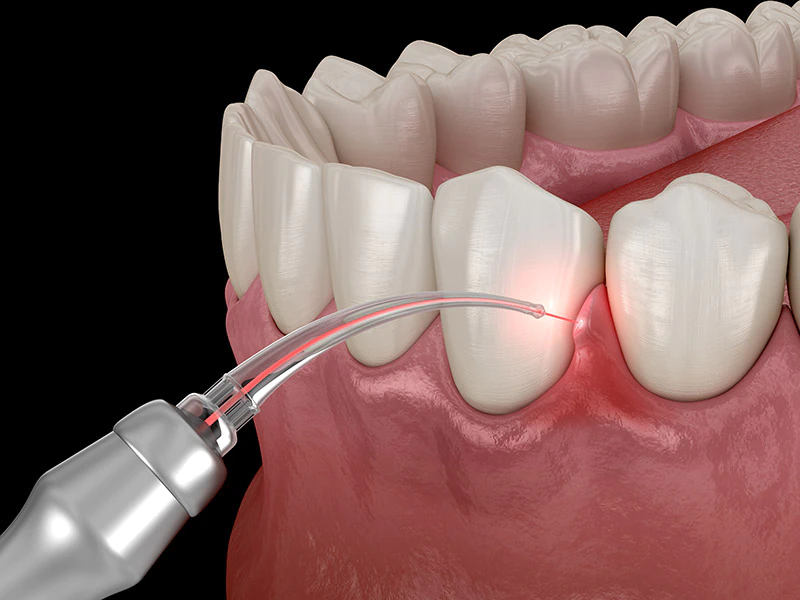 laser dentistry used at Lee Dentistry