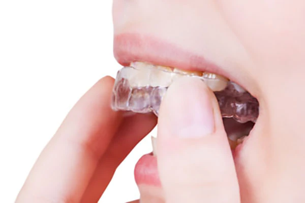 Invisalign Oxford, MS