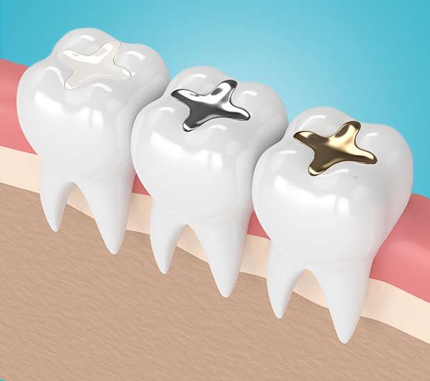 Oxford Composite Fillings