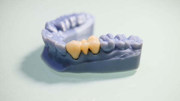 Why Dental Bridges Are Still A Smart Choice