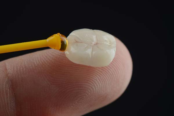 Can You Notice Dental Crowns On Front Teeth?