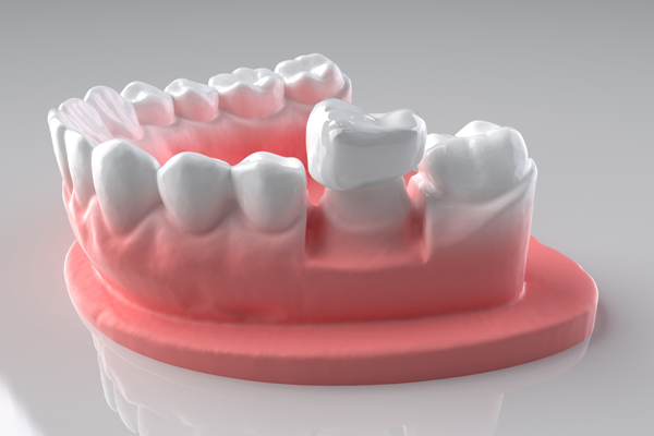 The Steps Of A Dental Crown Restoration
