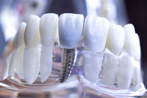 Dental Implants Oxford, MS