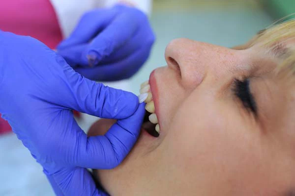 Dental Veneers Oxford, MS