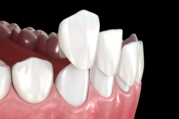 Surprising Benefits Of Getting Dental Veneers