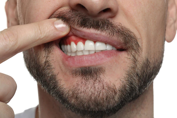 Gum Disease Treatment Oxford, MS