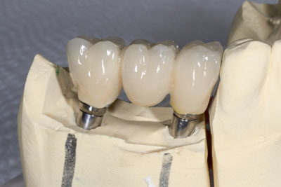 implant supported dentures Oxford, MS