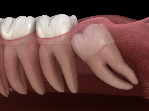 wisdom tooth extraction Oxford, MS